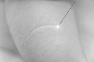 Laser eliminer cicatrice lyon clinique crillon medecine chirurgie esthetique centre laser