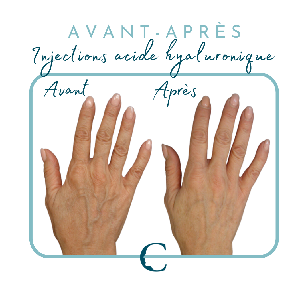 Traitements mains Lyon 