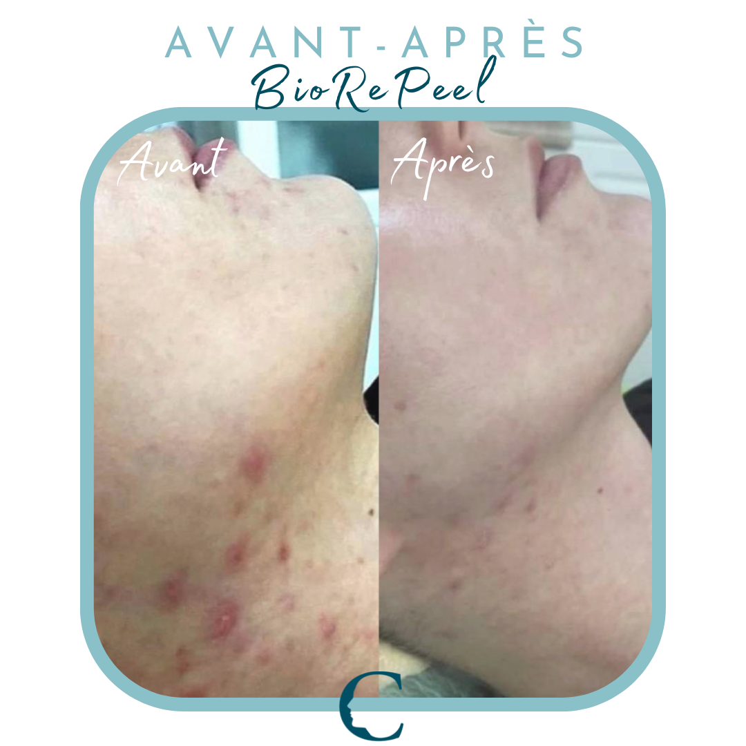 BioRePeel Lyon 