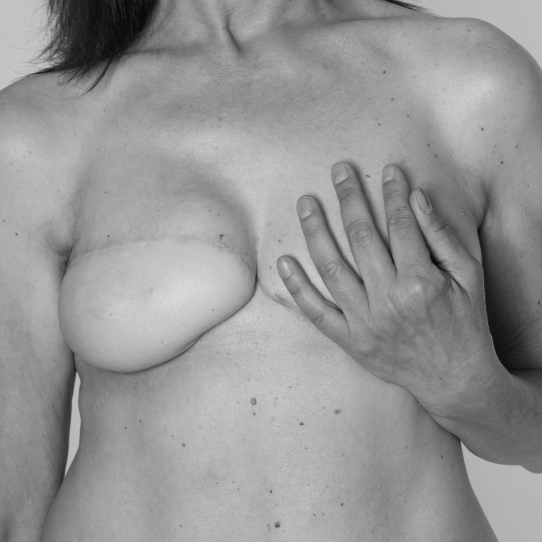 La dermopigmentation d'aréoles mammaires