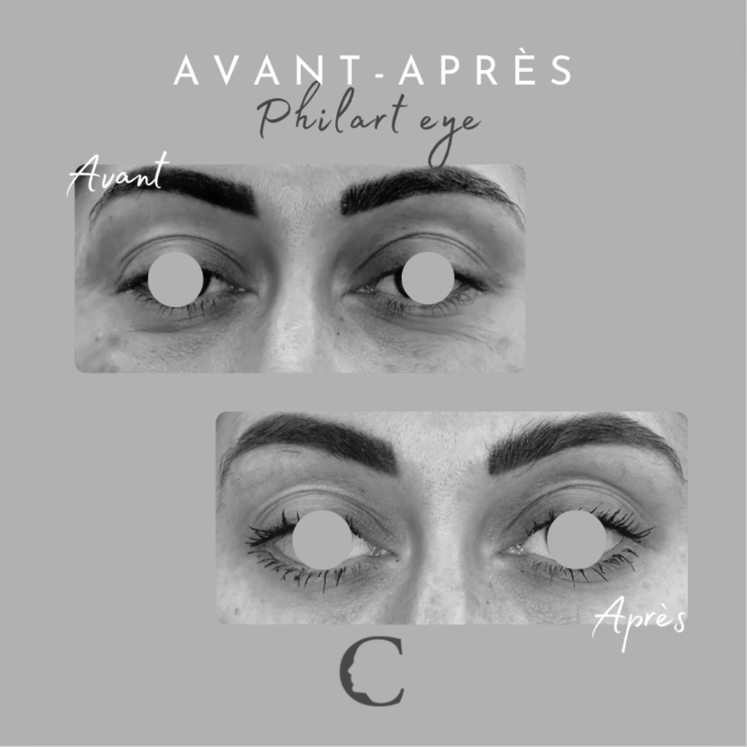 Les Polynucléotides  : PhilArt Eye
