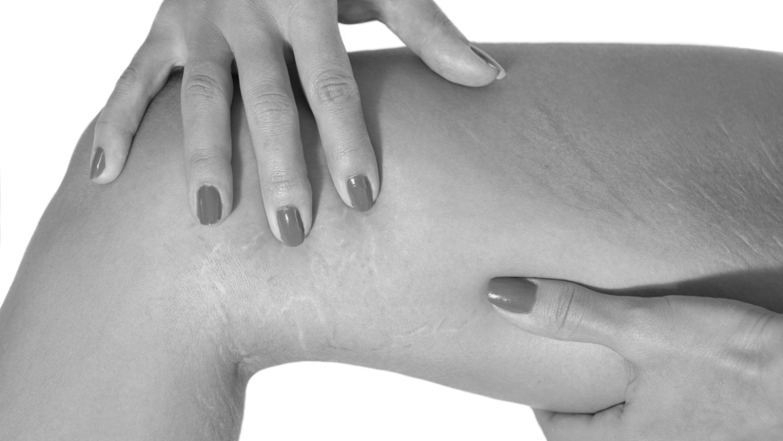 PRP la solution pour traiter et faire diminuer les vergetures