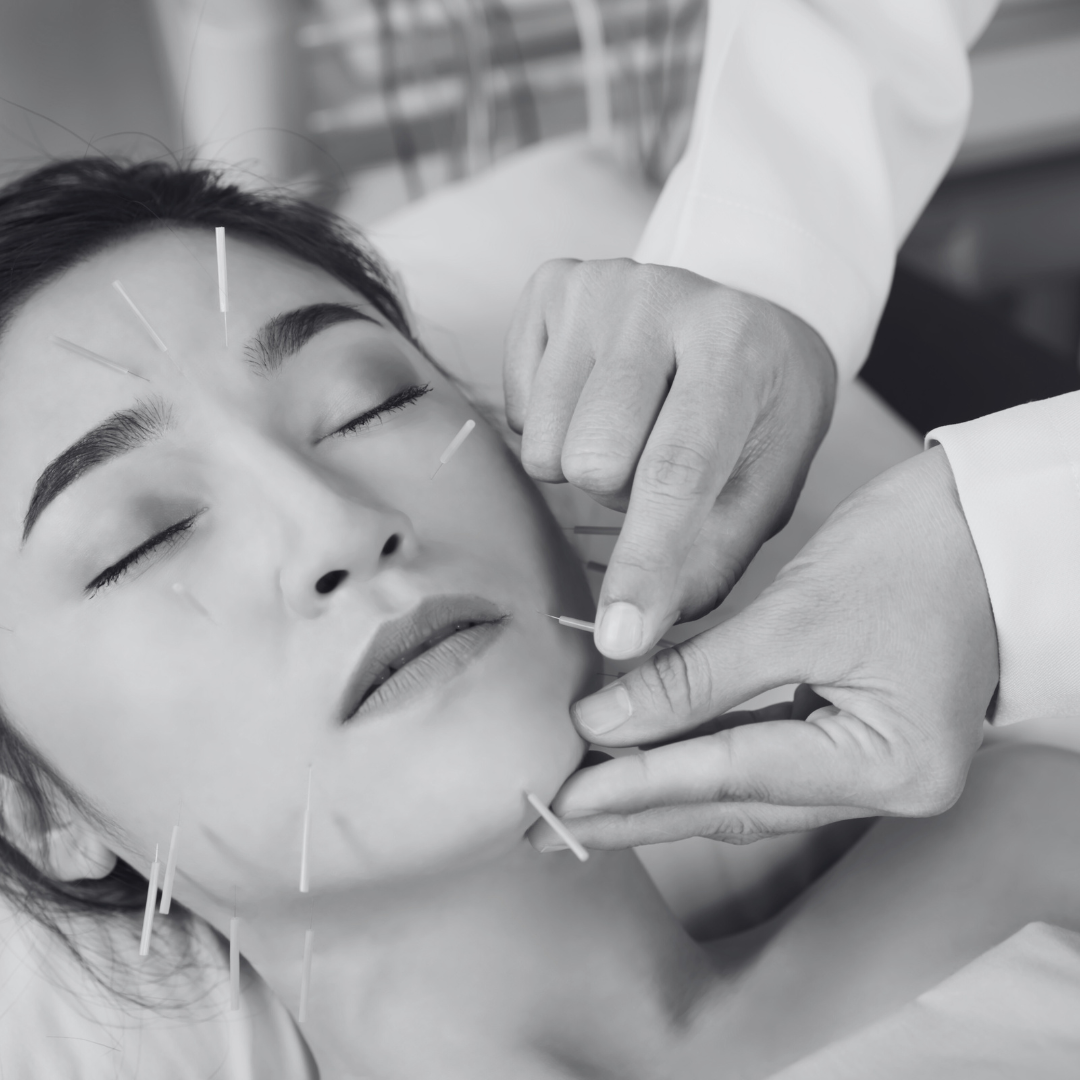 Prévenir le Relâchement Cutané avec l’Acupuncture : Une Solution Anti-âge Naturelle à Lyon
