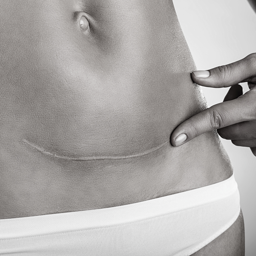 Comment atténuer la cicatrice d'une césarienne à Lyon