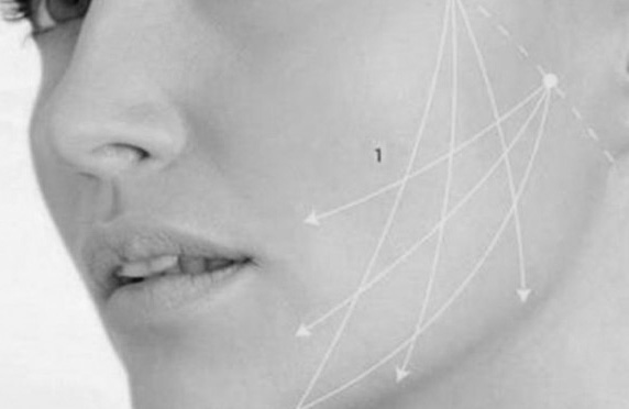 chirurgie esthétique fils tenseurs fils crantés Lyon Clinique Crillon