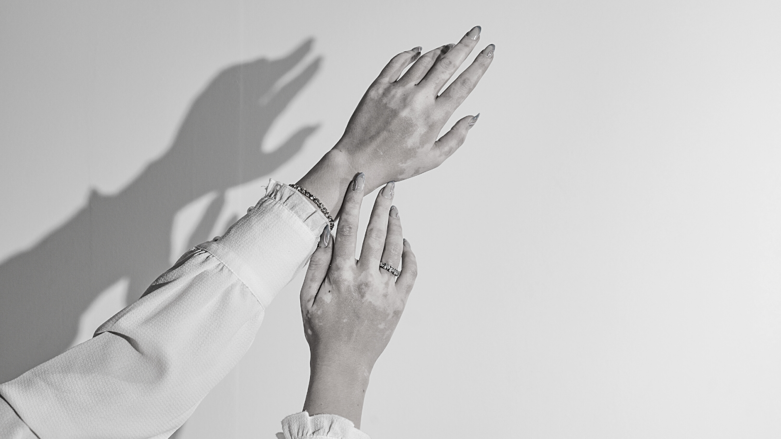 Traitements tâches sur les mains à Lyon